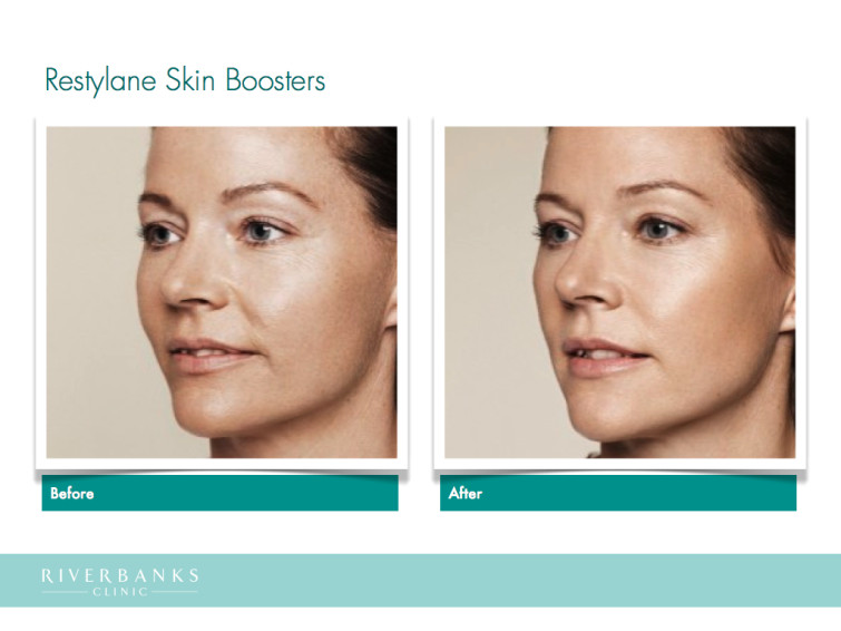 Restylane Skin Boosters.002