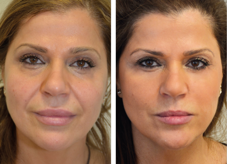 V-Soft-Lift-före-och-efter