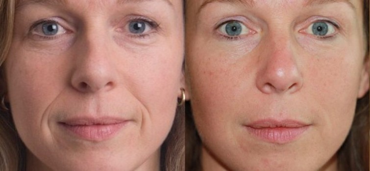dermal-fillers-before-after