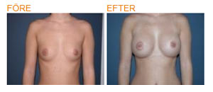 300x130-PKG-B-A-Mentor-Siltex-moderate-pluss-275cc-04