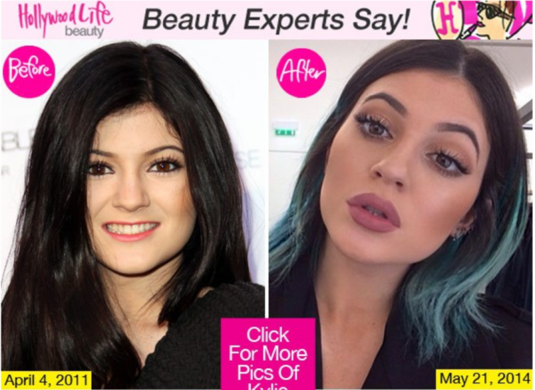 Kylie_Jenner_Pouty_Lips_2-1024x747